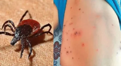 24 Scrub Typhus cases reported in Shimla, Don’t Mistake It for a Mild Fever…