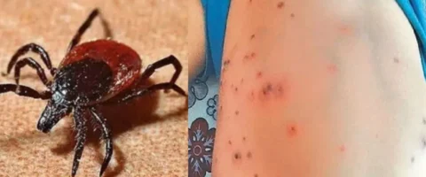 24 Scrub Typhus cases reported in Shimla, Don’t Mistake It for a Mild Fever…
