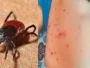 24 Scrub Typhus cases reported in Shimla, Don’t Mistake It for a Mild Fever…